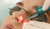 Laser Resurfacing