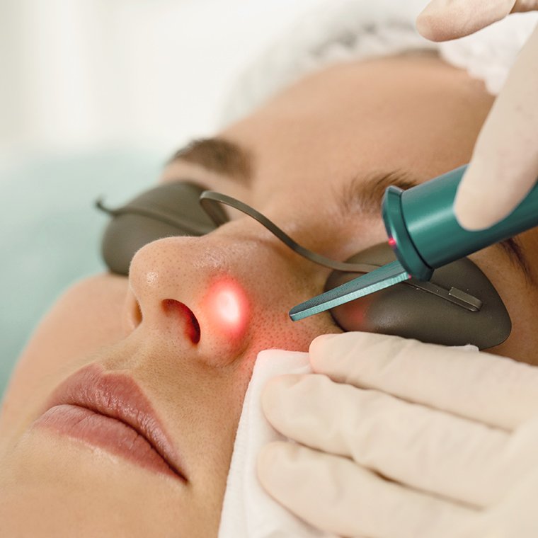 Laser Resurfacing
